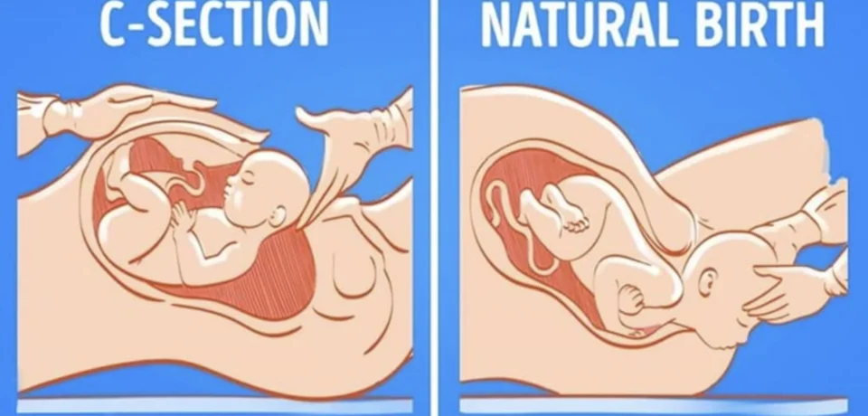 c section or natural c section or natural